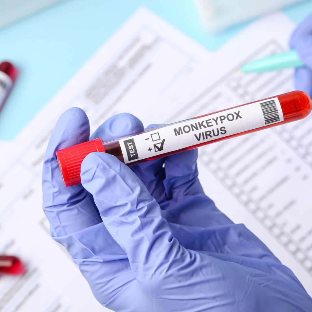 Nova pesquisa SindHosp aponta dificuldades no diagnóstico de Monkeypox